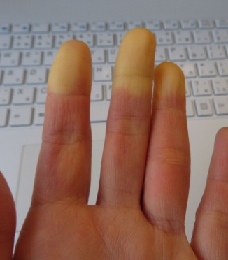 Raynaud-Syndrom und Schlaf — warum Hände und Füße nachts frieren und wie man dagegen vorgeht Raynaud-Syndrom und Schlaf — warum Hände und Füße nachts frieren und wie man dagegen vorgeht