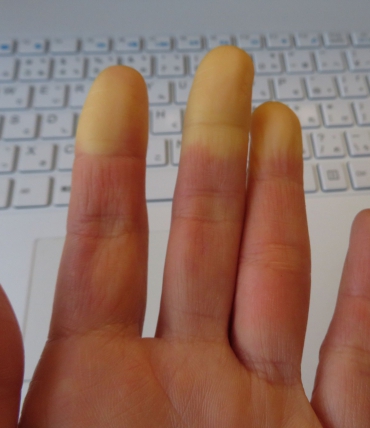 Raynaud-Syndrom und Schlaf — warum Hände und Füße nachts frieren und wie man dagegen vorgeht